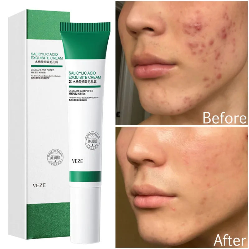 Pore-Refining Salicylic Acid Cream